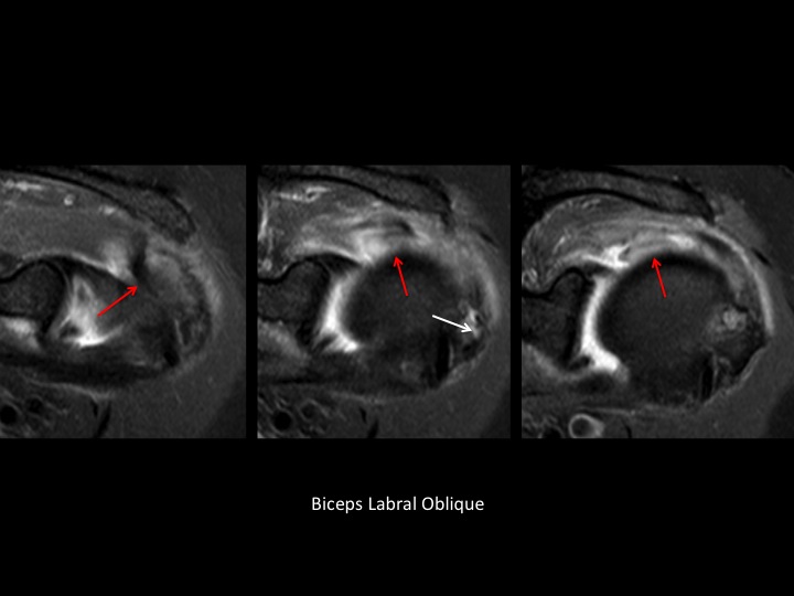Figure 4 for case tendon of rotator cuff ( RID1948 )